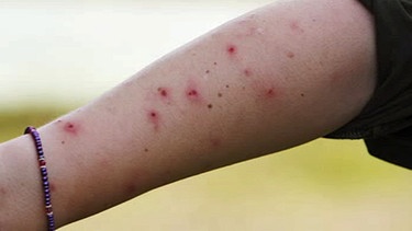 Hilfe bei Mückenstichen | Bild: BR