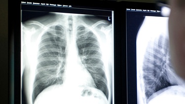 Arzt schaut auf ein Röntgenbild einer Lunge. | Bild: picture alliance / VisualEyze | Greenwood