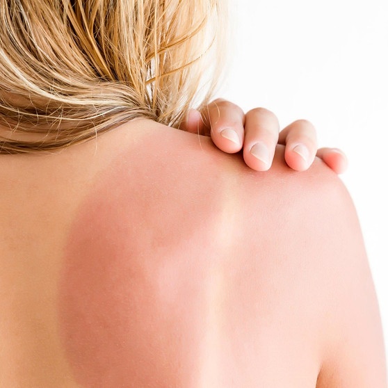 Schädlicher Sonnenbrand - so schützt du dein Kind!