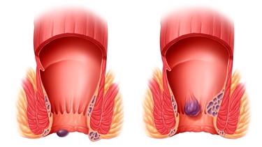 Hämorrhoiden | Bild: mauritius images / Science Source / Brian Evans