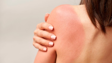 Eine Frau, man sieht sie nur von hinten, hat einen Sonnenbrand am Rücken | Bild: mauritius images / Dmitrii Pridannikov / Alamy / Alamy Stock Photos