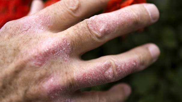 Psoriasis: Wie Schuppenflechte Haut Oder Gelenke Schädigt | Bayern 2 ...