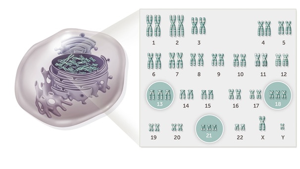 Abbildung der verschiedenen Trisomien, die auf einer genetischen Karte hervorgehoben sind.
Jede Person hat 22 Chromosomenpaare und zwei einzigartige Geschlechtschromosomen. Hier das X und Y eines kleinen Mädchens. Die Trisomie betrifft die Chromosomen 13, 18 und 21, die statt eines Paares drei identische Chromosomen aufweisen.
| Bild: picture-alliance/dpa