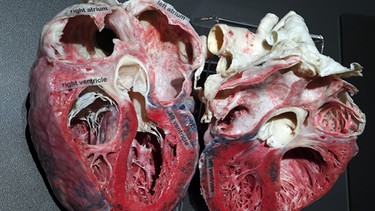 Querschnitt durch das menschliche Herz. Präparat aus dem Körperwelten-Museum | Bild: picture-alliance/dpa